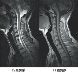 頚椎矢状断像